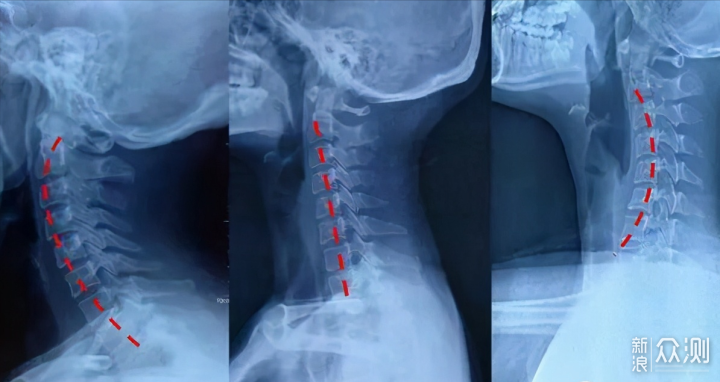 颈椎老病号护颈经验分享，4款颈椎按摩仪横评~ _新浪众测